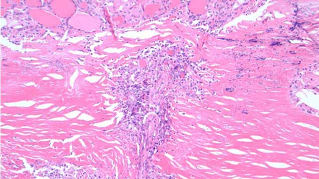 2023 Classic Lectures in Pathology: What You Need to Know: Endocrine Pathology - A CME Teaching Activity