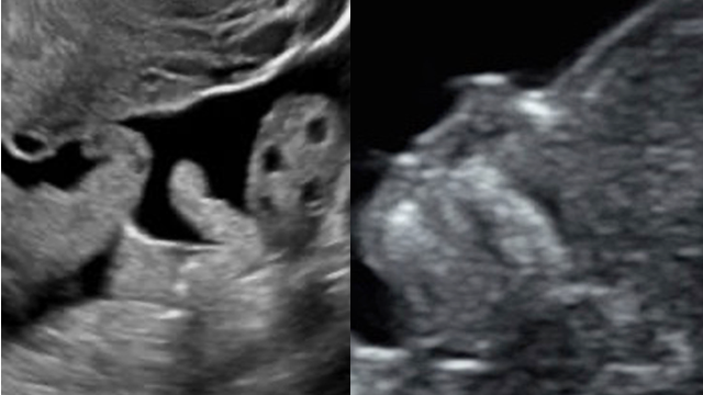 2023 Advances in First Trimester Ultrasound Imaging - A CME Teaching Activity