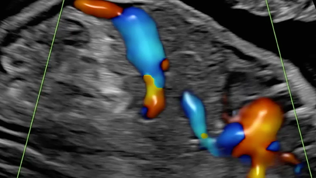 2024 Fetal Echocardiography: Normal and Abnormal Hearts - A Video CME Teaching Activity